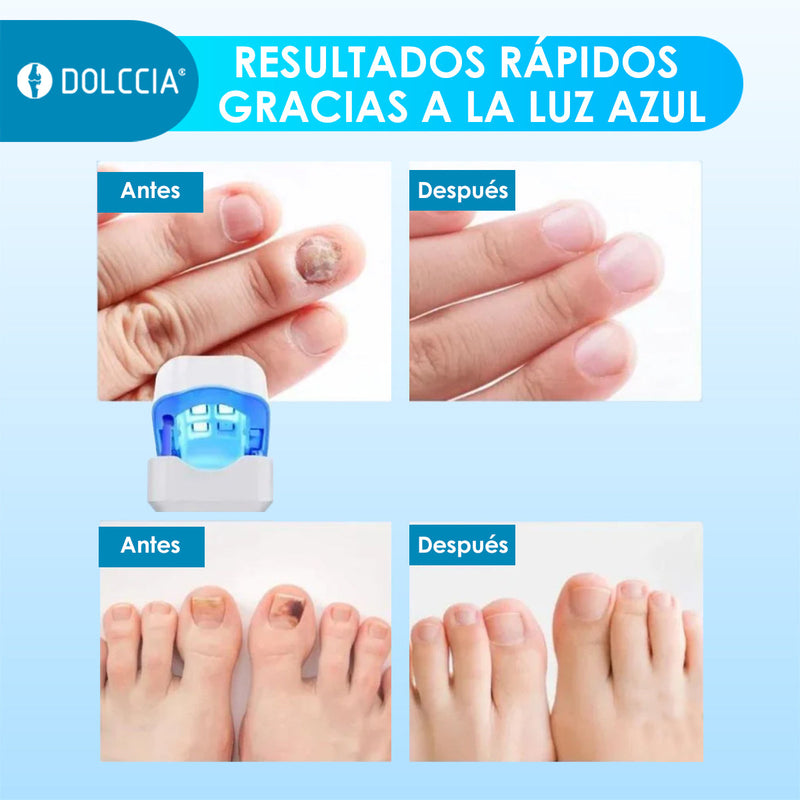 Hongomax: Tratamiento Láser para Restaurar Uñas